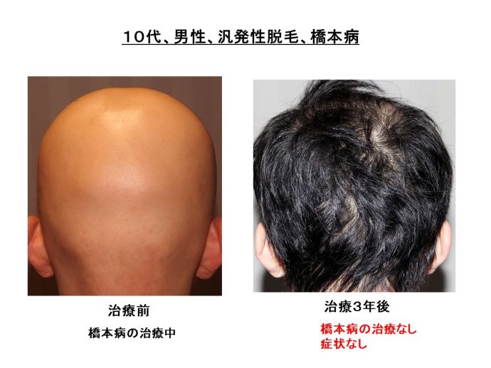 円形脱毛症　病院